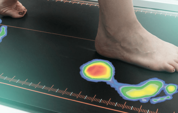 Static and Dynamic Foot Pressure Analysis